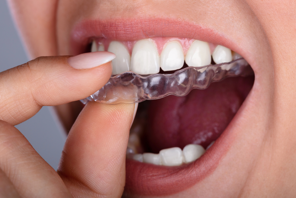 Close-up Of A Woman's Hand Putting Transparent Aligner In Teeth