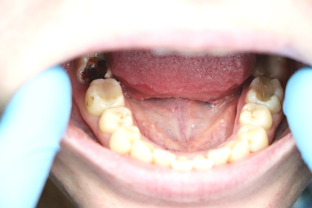 Deep caries, open canals, cleaning canals.