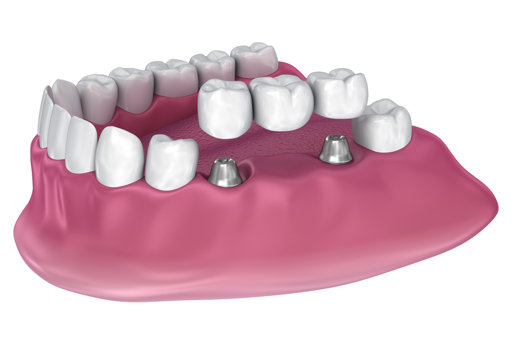 Implant supported fixed bridge