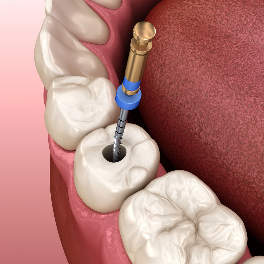Endodontic root canal treatment process