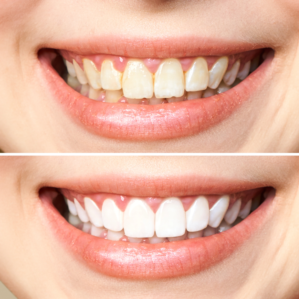 Woman teeth before and after whitening.