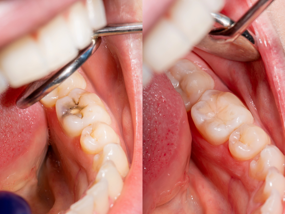 Caries and tooth disease. Filling with a dental composite photop