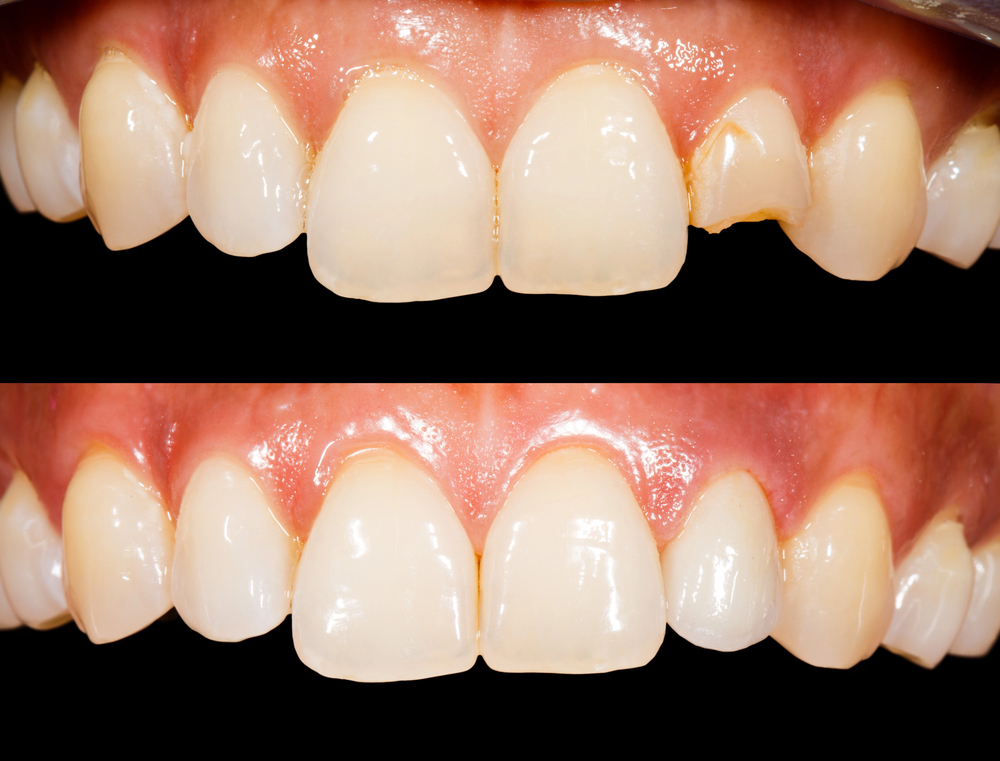 Close up photo of teeth before and after treatment