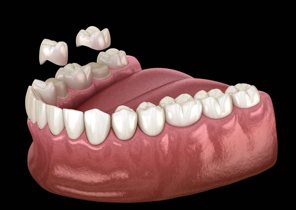 Porcelain crowns placement over premolar and molar teeth