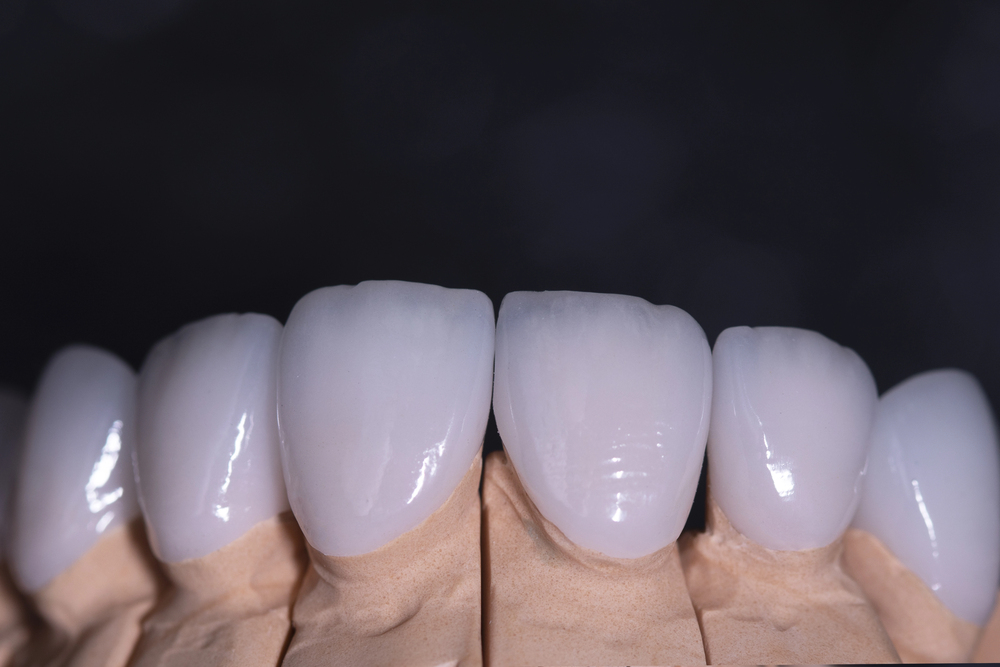 Porcelain veneers macro photography
