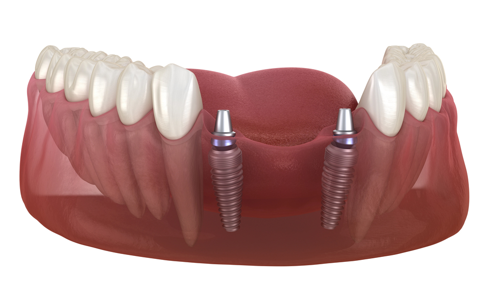 Frontal teeth bridge supported by implants.