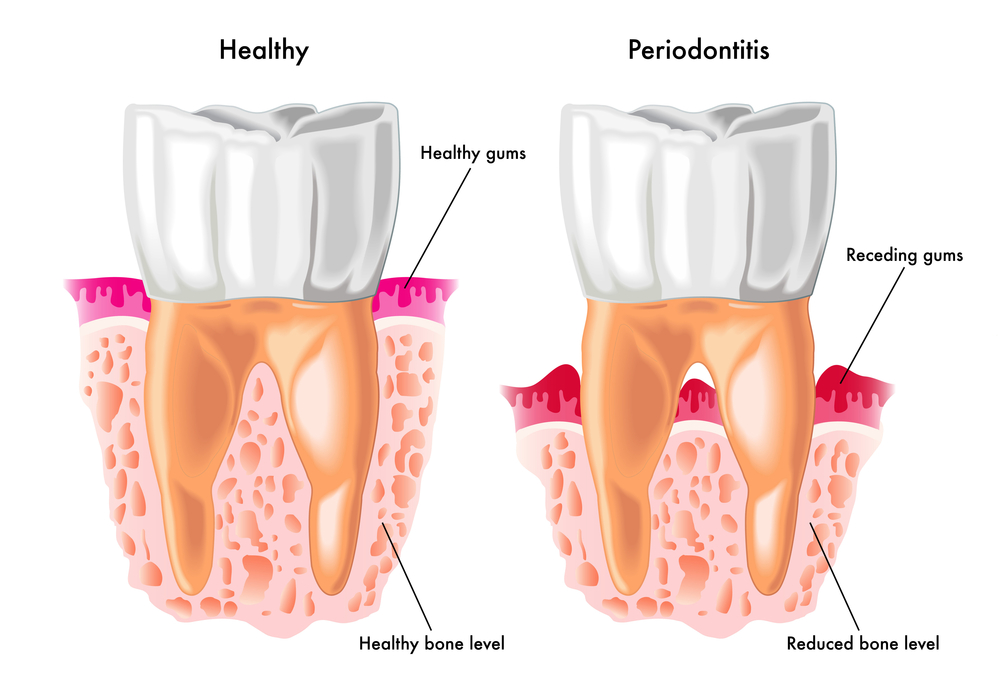 Detailed human Periodontitis