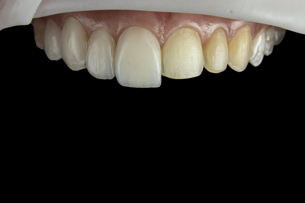 Intraoral photography of the adaptation trial of porcelain veneer