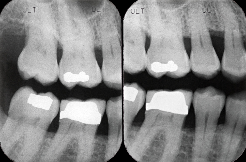 Left Periodontal X ray