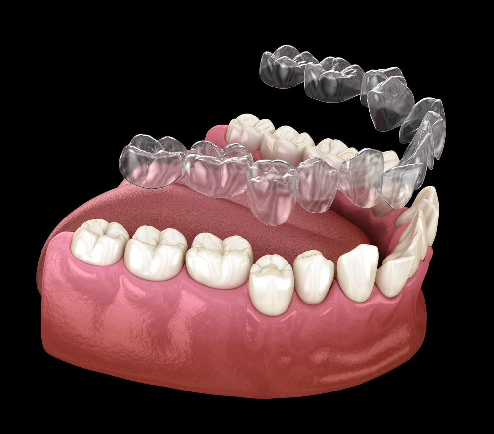 Remove BG Save Share Sample Invisalign braces or invisible retainer make bite correction