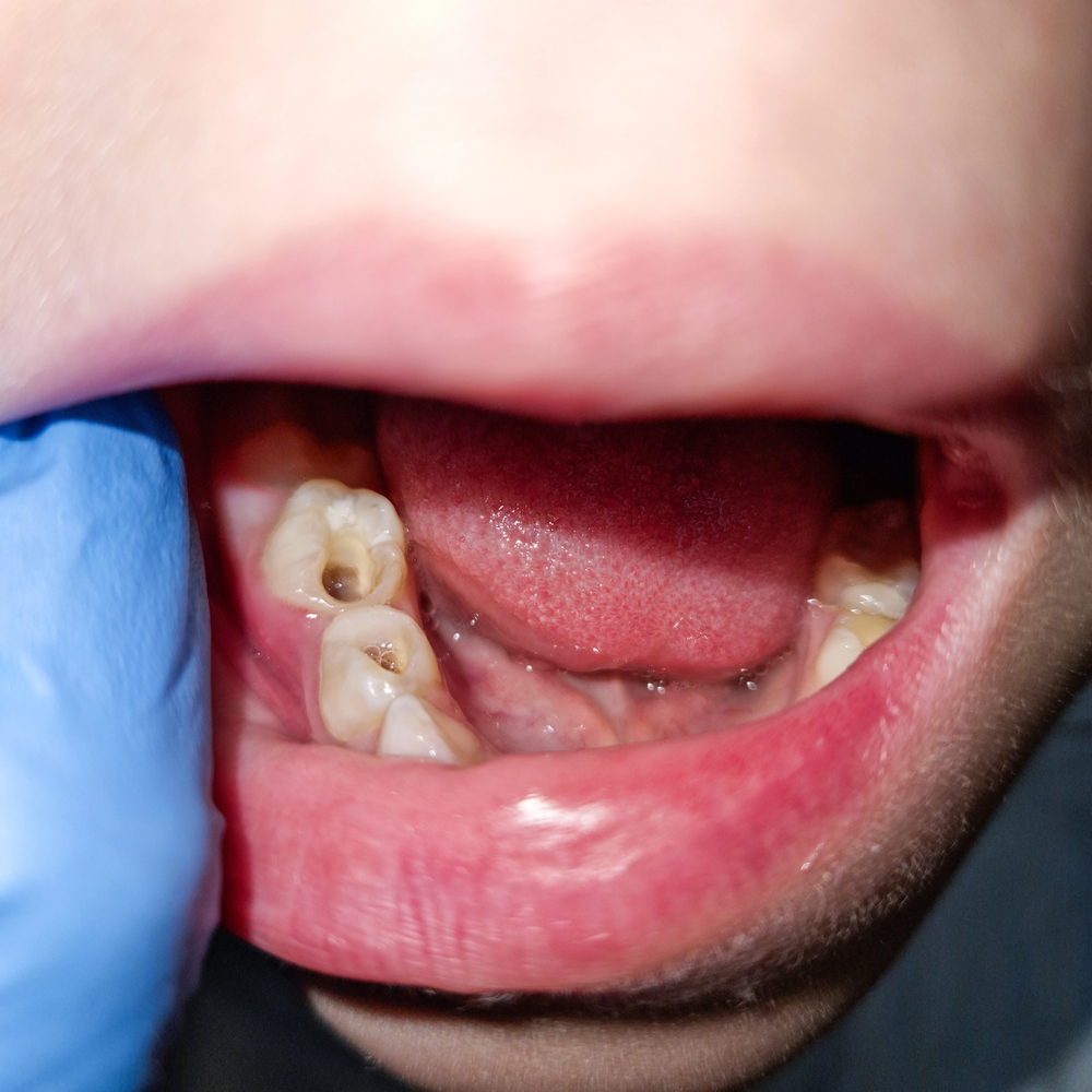 Close-up of a child's molars after dental root canal treatment
