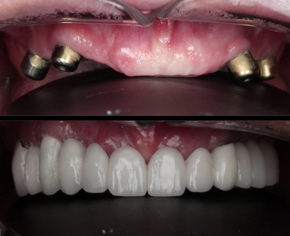 In dental dentistry, a full arch dental prosthesis
